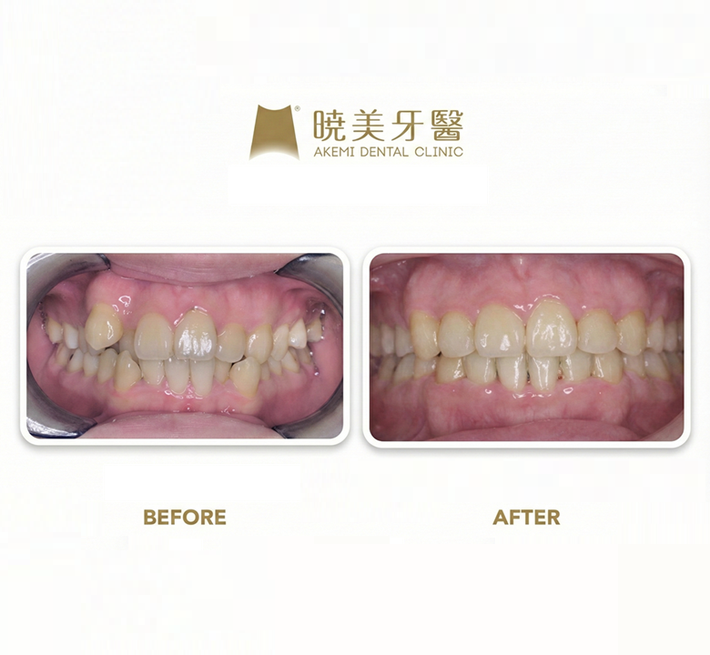執業多年的牙醫師林之驊的牙齒矯正實際案例，於位南港的暁美牙醫Akemi Dental clinic診間，專攻齒顎矯正、兒童牙科、隱形矯正、舌側矯正、數位齒顎矯正、舌側隱形矯正